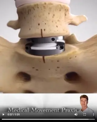 Bild "Mein Implant:Bandscheibenprothese_Video_320_402.webp"